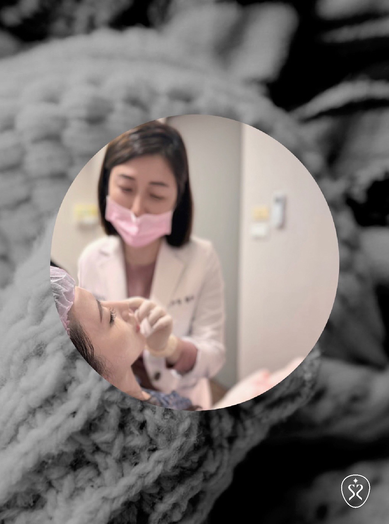 薇貝拉大分子為大型PDLLA晶球與玻尿酸組成，可以改善在較深層的皮下凹陷問題